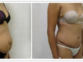 Antes y después de abdominoplastia