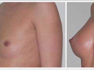 Antes y después de aumento de senos