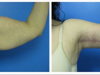 Antes y despues de braquiplastia