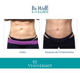 Antes y después de  Lipoescultura no invasiva | Venus Legacy | Venus Concept