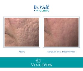 Antes y después de Resurfacing ! Venus Viva | Cicatrices de acné 