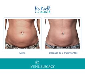 Antes y después de Lipoescultura no invasiva | Venus Legacy | Venus Concept