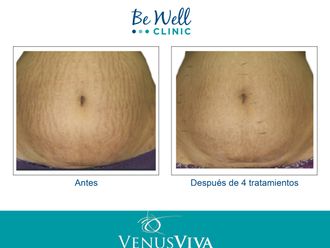 Eliminación estrías antes y después - 661500