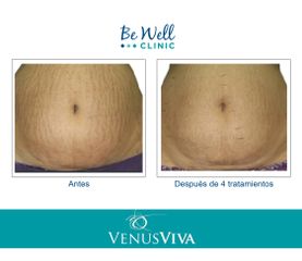 Antes y después de tratamiento de Estrías | Resurfacing | Venus Viva 