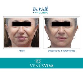 Antes y después de Reducción de Arrugas | Resurfacing | Venus Viva
