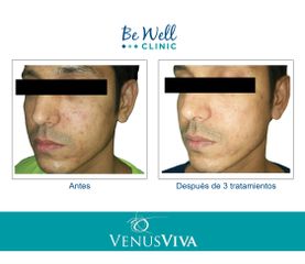 Antes y después de  tratamiento Marcas de Acné | Resurfacing | Venus Viva