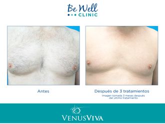 Depilación láser antes y después - 662318