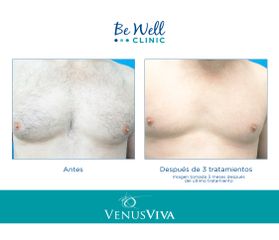 Antes y después de Depilación Láser Masculina | Venus Concept | Venus Velocity