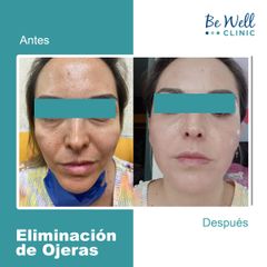 Antes y después de Eliminación de Ojeras | Ácido Hialurónico | Adiós Ojeras - Be Well Clinic