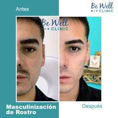 Antes y después de Masculinización de Rostro | Ácido Hialurónico - Be Well Clinic