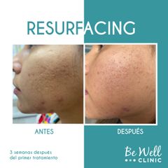 Antes y después de Resurfacing ! Venus Viva | Cicatrices de acné  - Be Well Clinic