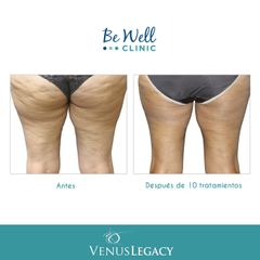 Antes y después de tratamiento anticelulítico| Venus Legacy | Lipoescultura no invasiva 