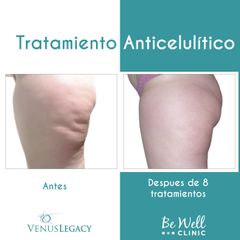 Antes y después de tratamiento anticelulítico | Venus Legacy | Lipoescultura no invasiva | 