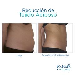 Antes y después de Lipoescultura no invasiva | Venus Legacy | Venus Concept