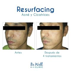 Antes y después de Resurfacing | Venus Viva | Cicatrices de acné - Be Well Clinic