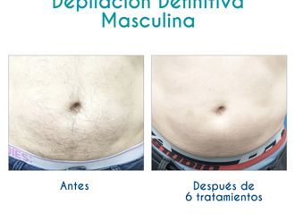 Depilación láser antes y después - 701053