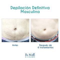Antes y después de Depilación Láser Masculina | Venus Concept | Venus Velocity
