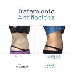 Antes y después de Radiofrecuencia - Be Well Clinic