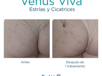 Eliminación estrías antes y después - 738420