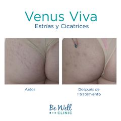 Antes y después de  tratamiento de Estrías | Cicatrices | Resurfacing - Be Well Clinic