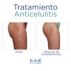Antes y después de Tratamiento anticelulitis - Be Well Clinic