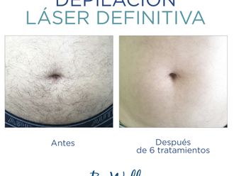 Depilación láser antes y después - 739568