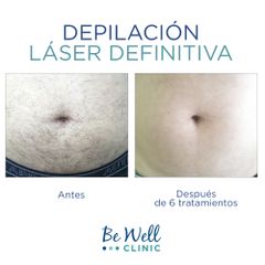 Antes y después de Depilación láser - Be Well Clinic