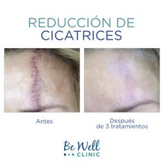 Antes y después de Cirugía para cicatrices - Be Well Clinic