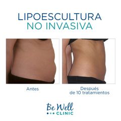 Antes y después de Lipoescultura no invasiva | Venus Legacy | Venus Concept - Be Well Clinic