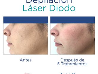 Depilación láser antes y después - 740341
