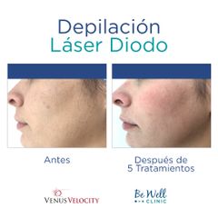 Antes y después de Depilación Láser de Diodo | Venus Concept | Venus Velocity
