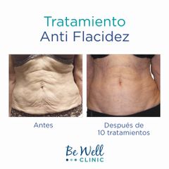 Antes y después de Tratamiento Antiflacidez | Venus Legacy