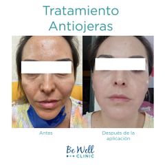 Antes y después de Tratamiento contra Ojeras | Acído Hialurónico - Be Well Clinic