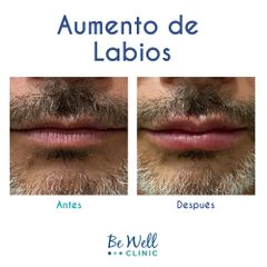 Antes y después de  Aumento de Labios | Relleno de Labios Ácido Hialurónico