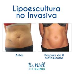 Lipoescultura - Be Well Clinic