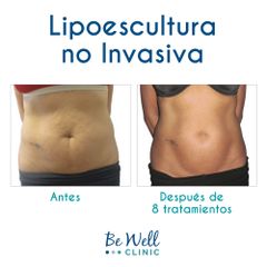 Antes y después de Liposucción - Be Well Clinic