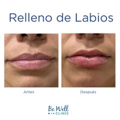 Antes y después de Aumento de labios - Be Well Clinic