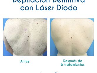 Depilación láser antes y después - 786077