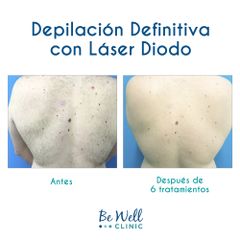Antes y después de Depilación Láser de Diodo | Venus Concept | Venus Velocity