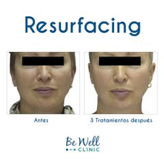 Resurfacing ! Venus Viva | Cicatrices de acné  - Be Well Clinic