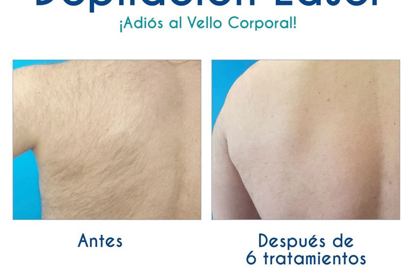 Depilación láser antes y después - 788263