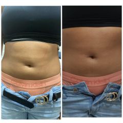 Antes y después de Radiofrecuencia - Be Well Clinic