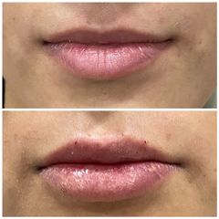 Antes y después de un aumento de labios - Be Well Clinic