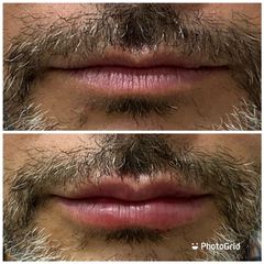 Antes y después de una aumento de labios - Be Well Clinic