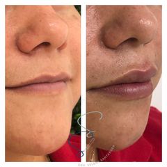 Aumento de labios - Dra. Selene Artemisa Santander Flores