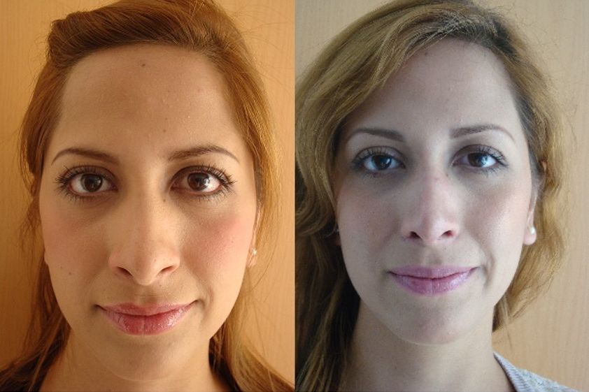 Bolsas de Bichat antes y después - 306585