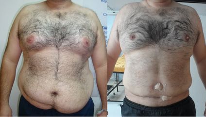 Abdominoplastia