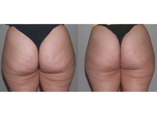 Anti celulitis