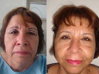 Blefaroplastia