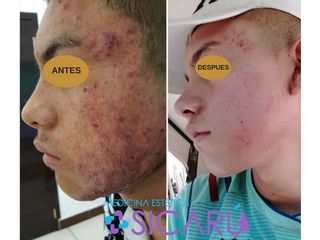 Antes y después de tratamiento de acné